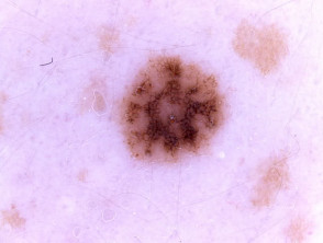 Dermoscopy of melanocytic naevus