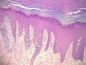 Histology of acral melanoma