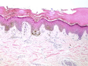 Histology of acral melanocytic naevus