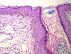 Histopathology of facial melanoma in situ (lentigo maligna)