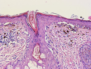 Circles on dermatoscopy of facial melanoma in situ, lentigo maligna