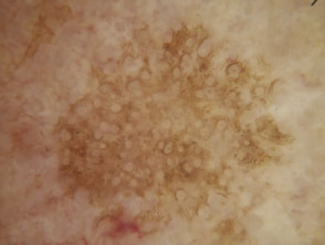 Grey circles seen in dermoscopy of a facial solar lentigo.