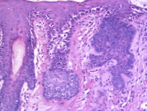 Histopathology of pigmented actinic keratosis