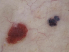 Red and blue clods on dermatoscopy of haemangioma