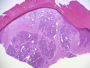 Histopathology of pyogenic granuloma