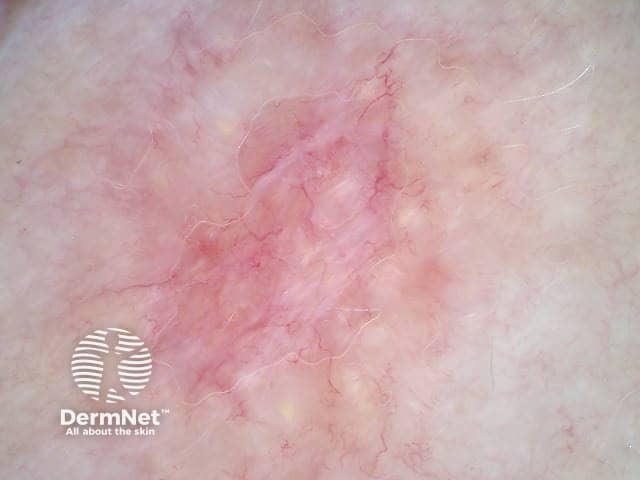 Cystic basal cell carcinoma (polarised view showing crystalline structures)