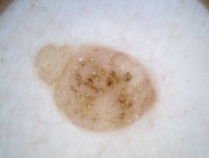 Dermatoscopy of papillomatous dermal melanocytic naevus