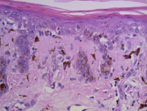 Lichen planus-like keratosis: dermatoscopy