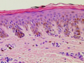 Histopathology of dysplastic naevus