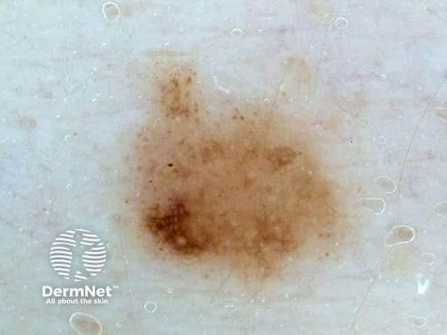 Eccentric hyperpigmentation
