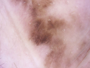  Dermatoscopic image of genital melanotic macule