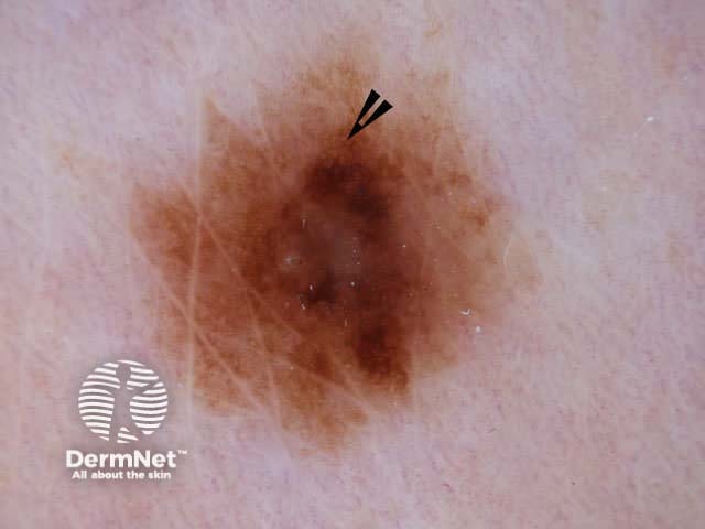 Melanoma
