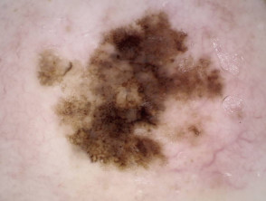 Dermatoscopy of melanoma with thick lines