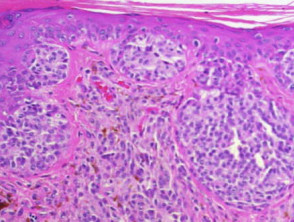 Histology of melanoma