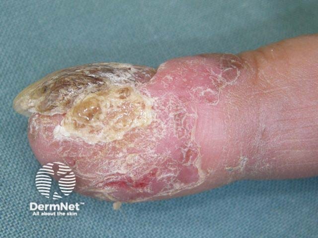 Squamous cell carcinoma in situ