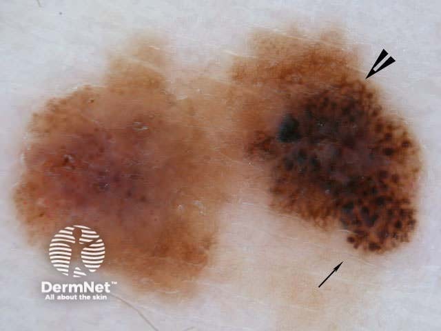 Melanoma