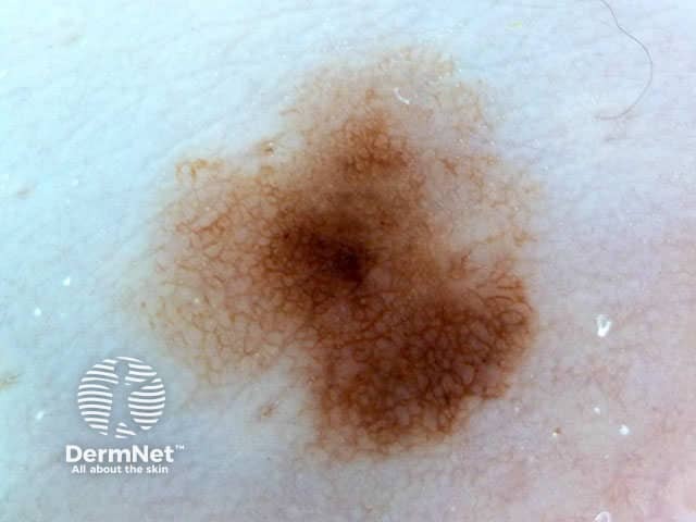 Reticular pattern