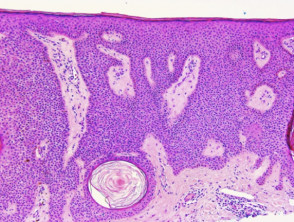 Histology of seborrhoeic keratosis