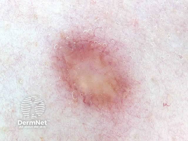 Irregular vascular pattern