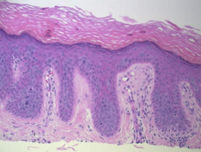 Histopathology of skin showing papillary vessels
