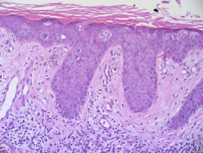 Histopathology of intraepithelial carcinoma