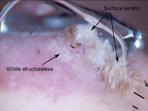 White structures and surface keratin in squamous cell carcinoma dermoscopy