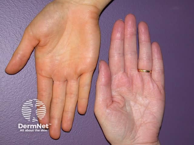 Carotenaemia (normal palm for comparison)
