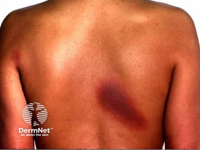 FDE due to cotrimoxazole