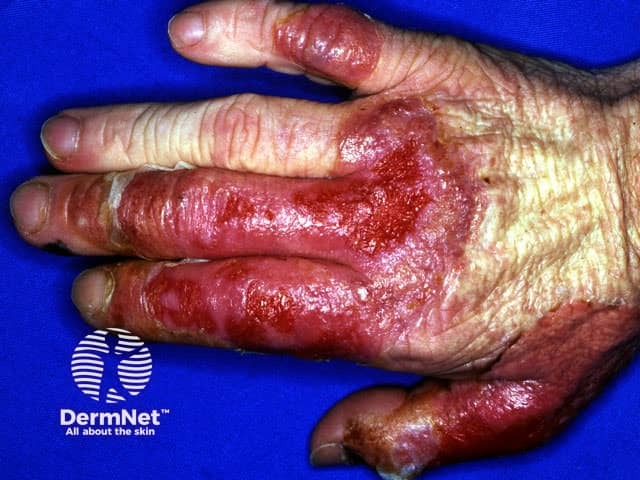 Sweet disease