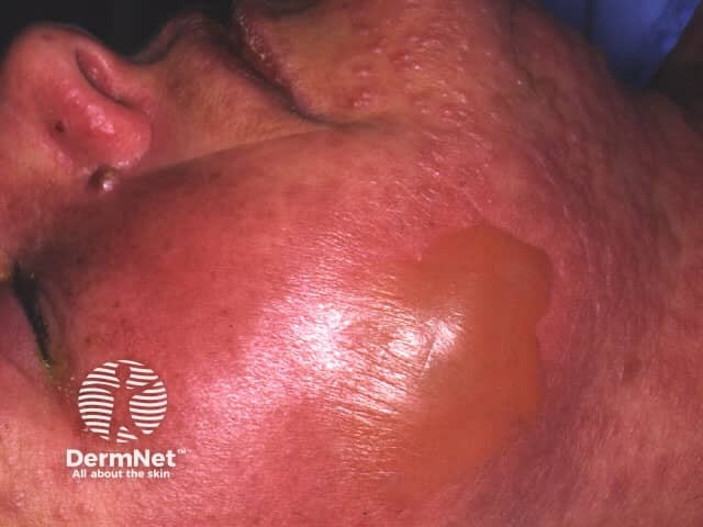 Toxic epidermal necrolysis