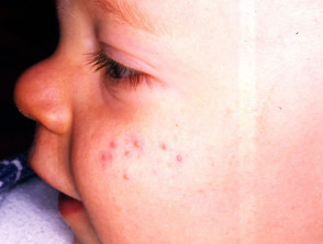 Infantile acne