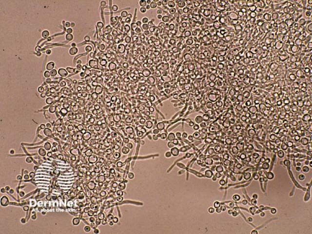 Candida albicans: microscopy and culture