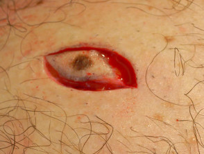 Cutting out a skin lesion
