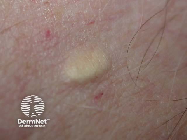 Solitary steatocystoma