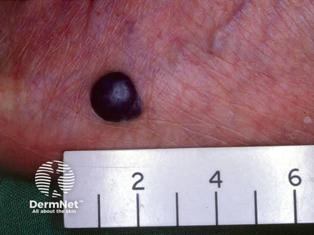 Black nodular melanoma