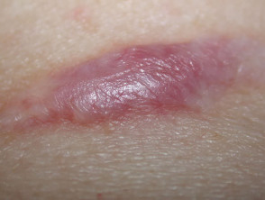 Scar after wound infection