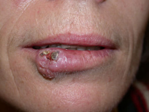 Squamous cell carcinoma of the lip