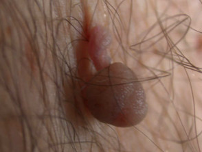 Skin lesion