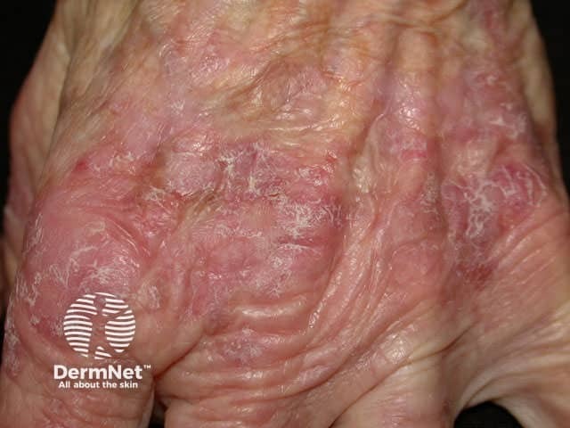 Diffuse actinic keratoses