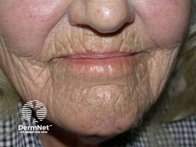 Furrows due to muscle movement