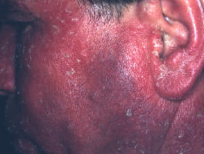 Eczematous eruption due to nonsteroidal anti-inflammatory drug