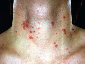 Acute dermatitis after using string trimmer