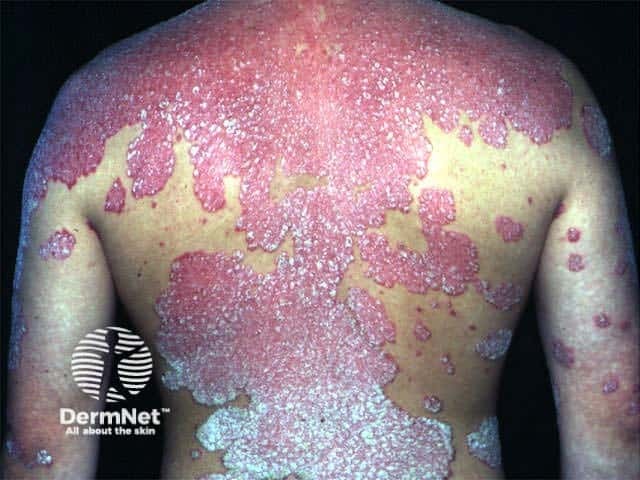 Extensive psoriasis prior to NB-UVB