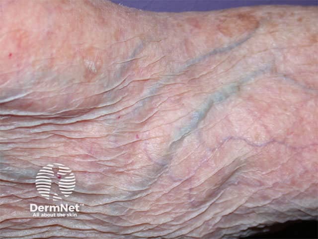 Thin transparent and wrinkled skin