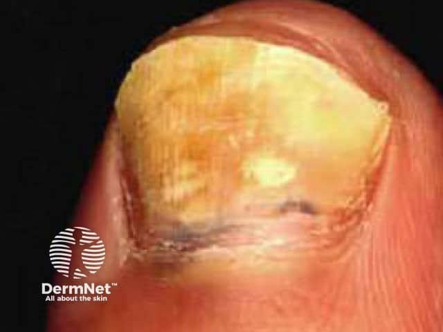 Onychomycosis