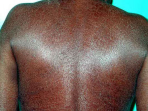 Acquired ichthyosis in kava drinker 