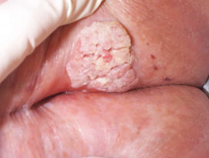 Perianal squamous cell carcinoma