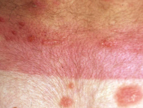 Photoxic erythema and blistering due to NB-UVB 
