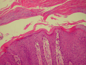 Inflammatory infiltrate in psoriasis
