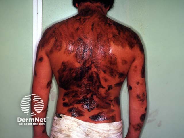 Crude coal tar ointment applied in Goeckerman regime